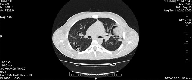 Рис. 1. КТ-ОГП пацієнта С. В обох легенях множинні інфільтративні вогнища за типом «матового скла» — симптоми «ореола» та декілька вогнищ із формуванням порожнини — симптом «півмісяця»