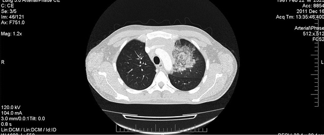 Рис. 2. КТ-ОГП пацієнта Т. У верхній частці лівої легені виявлено декілька вогнищ консолідації легеневої тканини за типом «матового скла»