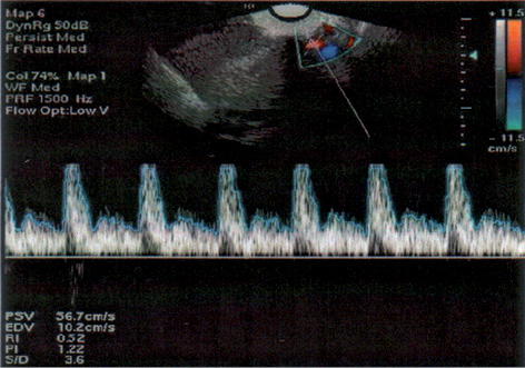 Рис. 4. Спектрограмма кровотока в маточных артериях