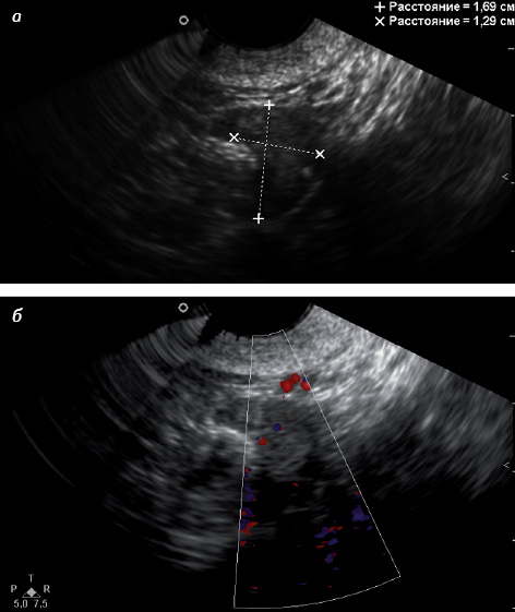 Рис. 5. Атрофичный яичник (пациентке 65 лет). а — эхографическое исследование; б — допплеровское картирование
