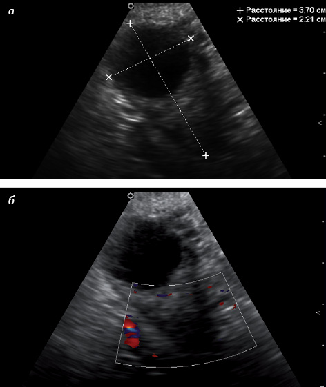 Рис. 6. Кистозный яичник (пациентке 62 года). а — эхографическое исследование; б — допплеровское картирование