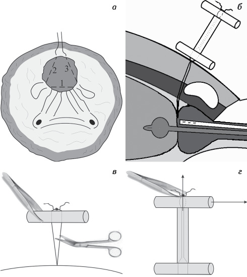 Рис. 1. Спосіб черезміхурової аденомектомії: а) проведення кисетного шва на шийку сечового міхура; б) відокремлення ложа передміхурової залози від порожнини сечового міхура; в) послаблення кисетного шва; г) видалення кисетної гемостатичної нитки