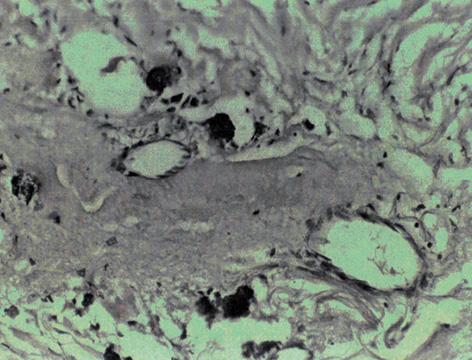 Рис. 4. Загиблі ракові клітини та їх скупчення (пухлинні емболи) у вигляді аморфних гематоксилінових тілець у просвітах венозних та лімфатичних судин. Периваскулярний парціальний некроз паренхіми та строми пухлини грудної залози. Стан після 4 курсів НПХТ. Гематоксилін-еозин. Зб. х200