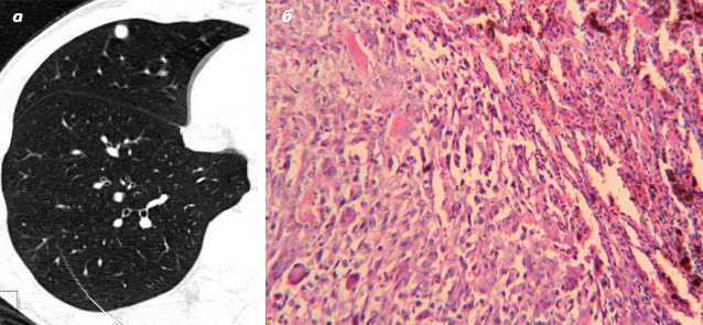 Рис. 2. Метастаз остеосаркомы: а — КТ правого легкого (узел подозрительный на метастаз); б — послеоперационный микропрепарат (малигнизированый узел)
