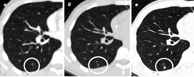 Рис. 3. КТ-изображения правого легкого ребенка в возрасте 7,5 года в динамике: а — узел не определяется; б – появился узел; в — узел через 1 мес увеличился в 2 раза