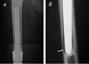 Рис. 2. Рентгенопрозрачная линия при асептическом расшатывании ножек ендопротеза