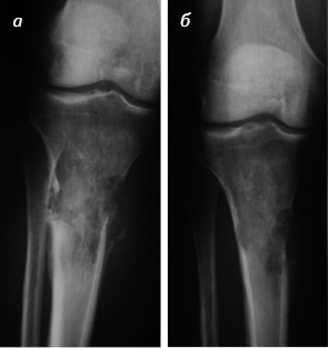 Рис. 3. Литическая деструкция кости: а) до проведения терапии; б) после проведенной терапии