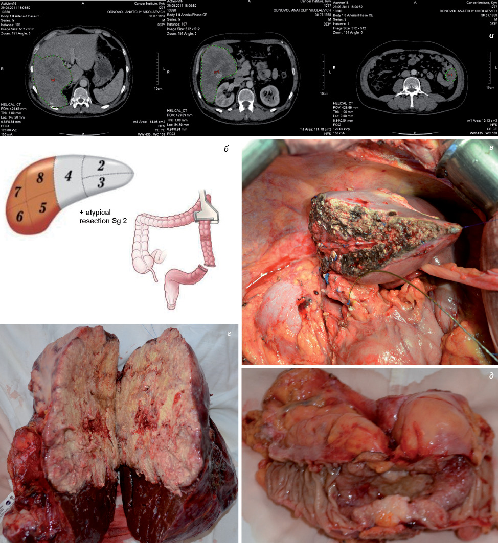 Рис. 1. Клинический пример (больной К). Выполнена синхронная резекция сигмовидной кишки с правосторонней гемигепатэктомией и атипической резекцией 2-го сегмента печени: а) результаты СКТ: поражение Sg 6, 7, 8 печени, экзофитная опухоль сигмовидной кишки; б) схема планируемой операции; в, г) виды операционного поля после правосторонней гемигепатэктомии (Sg 5, 6, 7, 8) и атипической резекции метастатического очага Sg 2;   д, е) макропрепарат: правая доля печени, пораженная метастазом, и сигмовидная кишка с первичной опухолью