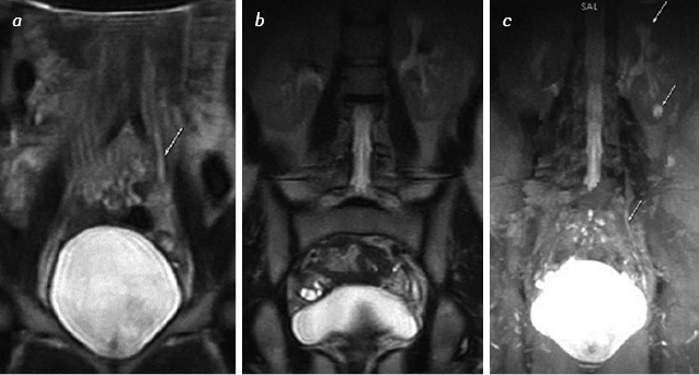 Fig. 1. MRI of patient O. with invasive bladder cancer, where: а, b) in Cor T2-weighted image the moderate dilatation of the left ureter in the form of a stasis of urine, the renal pelvis complex of the left kidney is structural, with preserved parenchyma; c) after Lasix administration: urine passes freely through the upper urinary tract, additionally, the cyst was detected in the lower pole of the left kidney