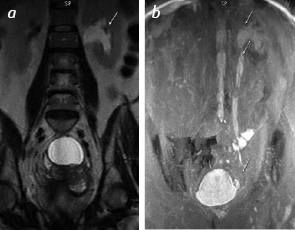 Fig. 2. MRI of patient M. with invasive bladder cancer, where: а) inCor T2-weighted image the moderate dilatation of left renal pelvis complex is observed, the parenchyma is preserved. Dilatation of the left ureter in distal part; b) after administration of Lasix the increase in dilation of the upper urinary tract was observed above the obstruction level