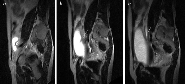 Fig. 3. Patient C. Bladder cancer condition after radical cystectomy, and ileoneocystoplasty; Sag T2-weighted image after administration of Lasix where: а) the ureter can be traced, more distal than dilatation area; b) the stricture is present of the left ureter in lower third up to 3 mm and within 20 mm of length; c) the dilated ureter is visualized above the stricture