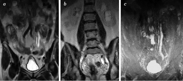 Fig. 4. MRI of patient L. with relapsing bladder cancer, where: а, b) in Cor T2-weighted image, the dilatation of the left doubled ureters is observed. The irregular thinning of renal parenchyma, and a treelike deformation of dilated calyx-pelvis complex were found, the level of obstruction is visualized; c) after administration of Lasix the increased ectasia is observed of the upper urinary tract on the left-side above the level of obstruction. A treelike dilatation of calyx-pelvis complex is observed, the left ureters are traced that are dilated all over the length to the iliac vessels. The bladder is filled, and deformed on the left rear wall