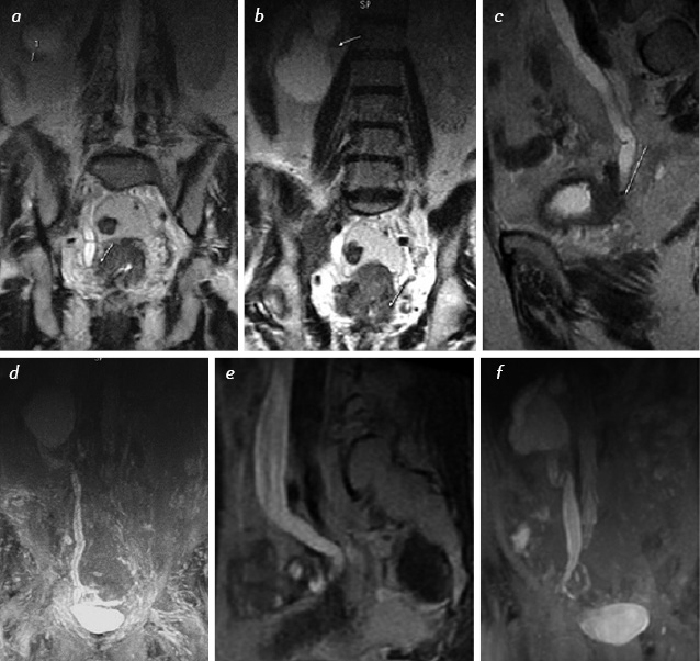 Рис. 5. MRI of patient Z. with invasive bladder cancer, where: а, b) in Cor T2-weighted image, a significant ectasia is observed of calyx-pelvis complex, the ureter is dilated, knee-like bended, the kidney parenchyma is thinned and is visualized fragmentarily, the level of obstruction is found; c) in Sag T2-weighted image the ureter above the obstruction is dilated. The cause of obstruction is tumor invasion in the area of the right meatus; d) the right upper urinary tract ectasia is observed above the level of obstruction. The bladder is filled and deformed on the right rear wall; e) after administration of Lasix the effect is insignificant, the ureter is atonic, dilated. Breakage of image and persistent filling defect in the projection of the distal part of right ureter and the right wall of the bladder