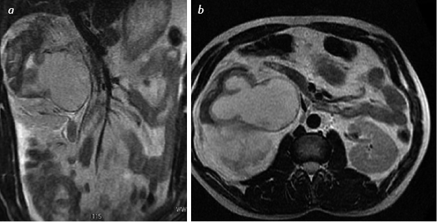 Fig. 6. Patient C. with urothelium cancer in calyx-pelvis complex of the right kidney, where: а) inCor T2-weighted image the obturation of ureter by tumor masses in the upper third,the kidney is in the form of polycystic formation; b) in AX T2-weighted image the perirenal tissue edema, and partial rupture of thinned renal parenchyma