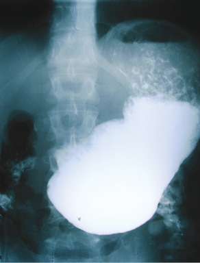 Рис. 3. Рентгенограмма желудка пациента А.