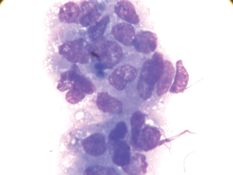 Рис. 1. Група пухлинних клітин ЕРЯ з поліморфними ядрами, нерівномірною структурою хроматину та вакуолізованою цитоплазмою. Забарвлення за Паппенгеймом. Зб. 1000