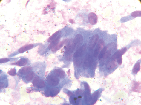 Рис. 3. Мономорфні високопризматичні та кубічні клітини ЕРЯ. Забарвлення за Паппенгеймом. Зб. 1000
