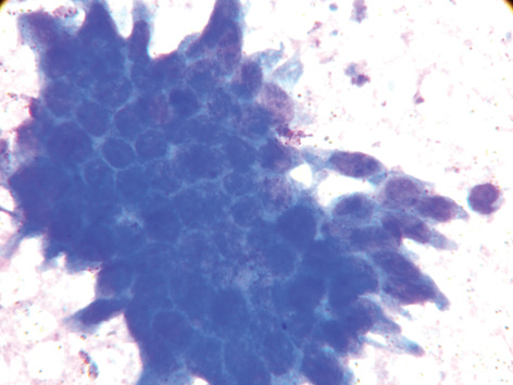 Рис. 4. Пласт пухлинних клітин з гіперхромними ядрами та густою базофільною цитоплазмою, що нагадує бджолині стільники. Забарвлення за Паппенгеймом. Зб. 1000
