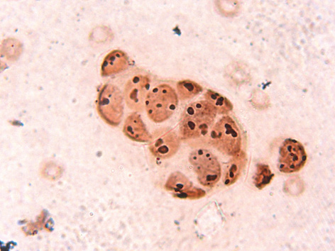 Рис. 6. Основні морфофункціональні типи ядерець, переважно компактні, в клітинах помірнодиференційованої ендометріоїдної карциноми яєчника. Забарвлення за Howell W., Black D. Зб. 1000.