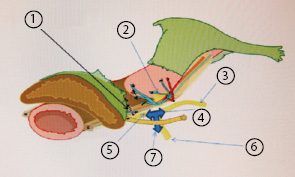 Рис. 14. Т-образная плоскость нерва. 1 — выделение паракольпиума (паравагинальной клетчатки); 2 — маточная ветвь; 3 — гипогастральный нерв; 4 — верхнее гипогастральное сплетение; 5 — пузырная ветвь; 6 — тазовый чревный нерв; 7 — Т-образная плоскость нерва