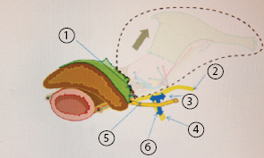 Рис. 15. Т-образная плоскость нерва и вид после экстирпации матки. 1 — после экстирпации матки; 2 — гипогастральный нерв; 3 — нижнее гипогастральное сплетение; 4 — тазовый чревный нерв; 5 — пузырная ветвь; 6 — Т-образная плоскость нерва