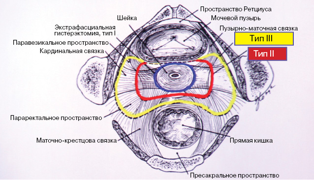 Рис. 1. Классификация M. Piver, F. Ratledge, J. Smith (горизонтальный срез таза) [23]