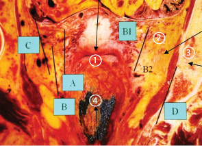 Рис. 3. Классификация D. Querleu, CP Morrow (горизонтальный срез таза). 1— влагалище;  2 — клетчатка таза; 3 — седалищная кость; 4 — прямая кишка 