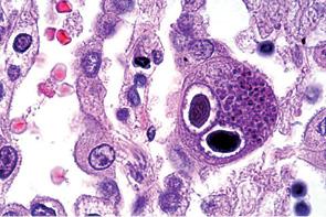 Рис. 1. Окрашивание гематоксилин-эозином ткани легкого. Типичные включения («глаза совы») (×480). Courtesy of Danny L Wiedbrauk, PhD, Scientific Director, Virology & Molecular Biology, Warde Medical Laboratory, Ann Arbor, Michigan