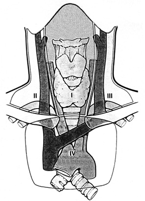 Рисунок. Басейни лімфатичного відпливу щитоподібної залози: І — центральний; ІІ — іпсілатеральний цервіколатеральний; ІІІ — контра­латеральний цервіколатеральний; ІV — середостінний