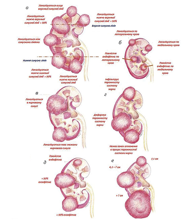 Рис. 2. Система оцінки PADUA: а) полярність розташування пухлини; б) край розташування пухлини; в) відносно миски нирки; г) відносно порожнистої системи нирки; д) відсоток пухлини, що вростає в нирку; е) максимальний діаметр пухлини