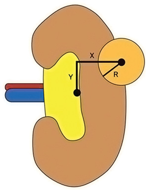 Рис. 7. Визначення горизонтальної (Х), вертикальної відстані (Y) та радіуса пухлини (R) згідно з системою C-index