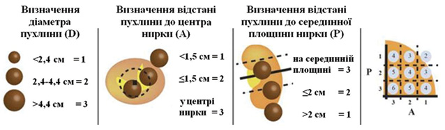 Рис. 8. Визначення діаметра, локалізації та розміщення пухлини згідно з системою D-A-P nephrometry