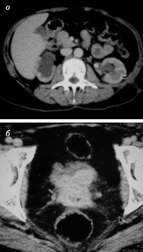 Рис. 1. Спіральна комп’ютерна томографія хворої О., 1966 р.н.: а) право­бічний уретерогідронефроз, нефро­стома зліва, паренхіма нирок стоншена; б) рецидив у малому тазу (55×46 мм) з поширенням на сечовий міхур