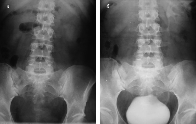 Рис. 3. Рентгенологічне обстеження хворої В., 1979 р.н.: а) оглядова урограма; б) екскреторна урограма (відсутність функції правої нирки, уретерогідронефроз зліва)