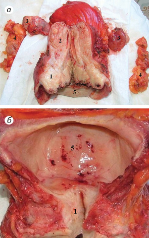 Рис. 6. Макропрепарат хворої В., 1979 р.н.: 1 — шийка матки; 2 — тіло матки; 3 — яєчники; 4 — здухвинні лімфовузли зліва і справа; 5 — сечовий міхур