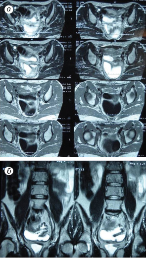 Рис. 7. Магнітно-резонансна томограма хворої В., 1979 р.н.: а) аксіальний зріз; б) коронарний зріз