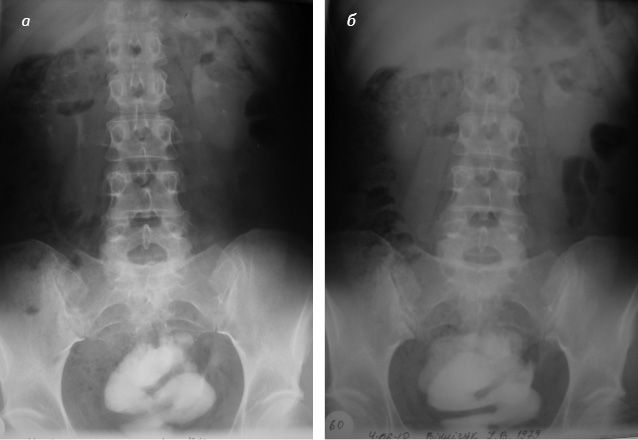 Рис. 8. Екскреторна урографія хворої В., 1979 р.н.: а) на 30-й хвилині; б) на 60-й хвилині
