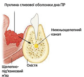 Рис. 1. Схематичне зображення механізму пухлинної інвазії НЩ