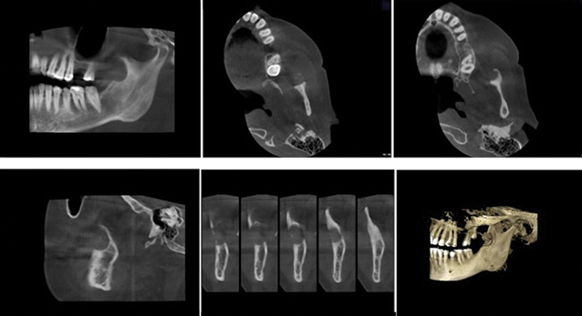 Рис. 2. Конусно-променева КТ (панорамний вигляд, аксіальні, сагітальні зрізи та 3D-реконструкція) пацієнта з пухлиною ретромолярної ділянки, що поширюється на гілку НЩ