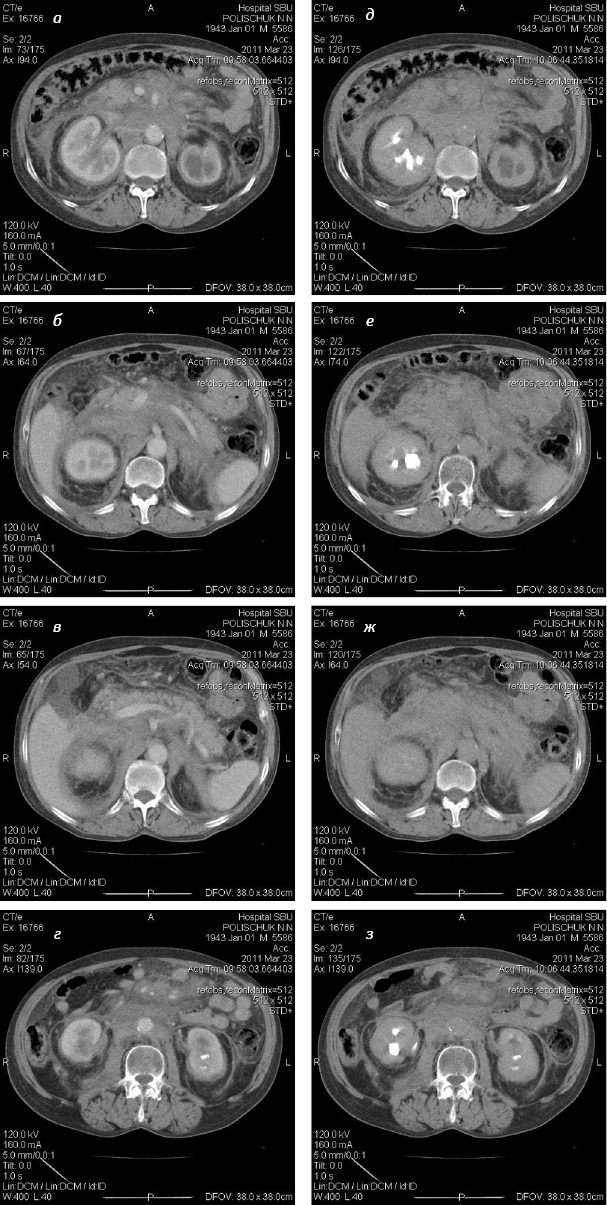 Рис. 2. КТ органов брюшной полости больного П. с внутривенным контрастированием. Инфильтрация клетчатки переднего параренального и периренального пространств с вовлечением в процесс магистральных сосудов. «Мутная» брыжейка. Гидронефротическая трансформация обеих почек. Конкременты левой почки. Утолщение фасции Герота (а–г — паренхиматозная стадия, д–з — экскреторная фаза)