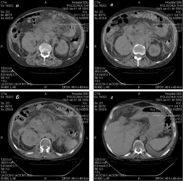 Рис. 4. КТ органов брюшной полости больного П. Инфильтрация клетчатки переднего параренального и периренального пространств. «Мутная» брыжейка. Асцит. Утолщение фасции Герота с обеих сторон