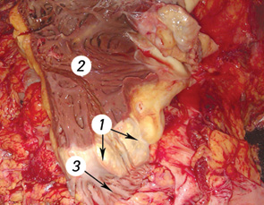 Рис. 8. Метастаз липосаркомы в стенку правого предсердия (вид на разрезе): 1 — липосаркома, 2 — правый желудочек, 3 — правое предсердие
