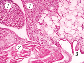 Рис. 9. Метастаз липосаркомы под эпикардом правого предсердия (окраска гематоксилином и эозином, ×100): 1 — липосаркома, 2 — миокард правого предсердия, 3 — полость правого предсердия