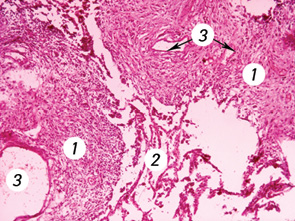 Рис. 10. Метастазы липосаркомы в легких (окраска гематоксилином и эозином, ×100): 1 — липосаркома, 2 — альвеолы, 3 — просвет сосудов