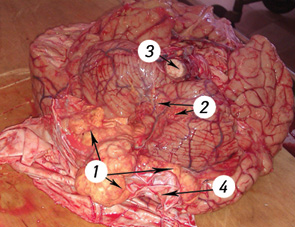 Рис. 11. Метастаз липосаркомы в головной мозг (вид снаружи): 1 — липосаркома, 2 — вдавление от липосаркомы в полушария мозжечка, 3 — продолговатый мозг, 4 — оболочки мозга
