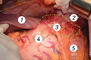 Рис. 2. Первичный вид операционного поля. 1 — печень, 2 — диафрагма, 3 — опухоль, 4 — тело желудка, 5 — нисходящая ободочная кишка