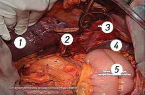 Рис. 3. Вид операционного поля после удаления макропрепарата. 1 — печень, 2 — пищевод, 3 — диафрагма, 4 — селезенка, 5 — петля тонкой кишки для эзофагоэнтероанастомоза