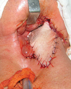 Рис. 4. Вигляд післяопераційної рани після заміщення дефекту м’яких тканин шиї та задньої стінки глотки
