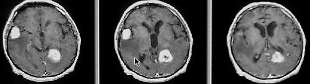 Рис. 1. МРТ Т1. Многоочаговая лимфома головного мозга