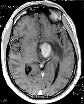 Рис. 2. МРТ Т1 с контрастным усилением. B-крупноклеточная лимфома в области зрительного бугра (интенсивное однородное накопление контраста, незначительный перифокальный отек)